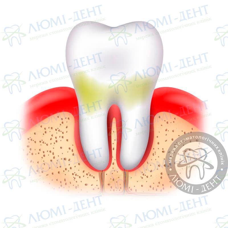 Лечение воспаления десен фото Люми-Дент
