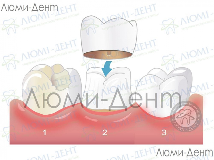 Стоматологическое протезирование зубов фото ЛюмиДент