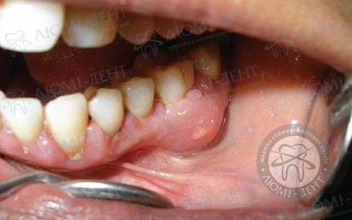 Зубная боль фото Люми-Дент