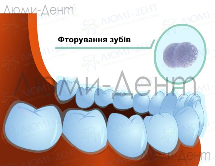 Ремінералізація зубів фото Люмі-Дент