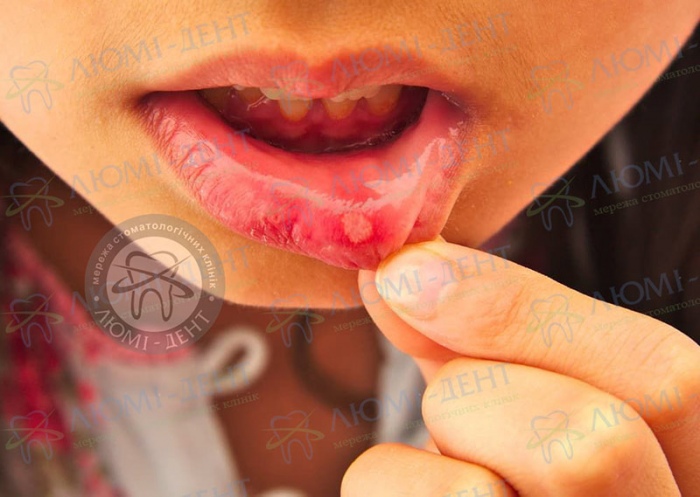 Виразка в роті фото Люмі-Дент