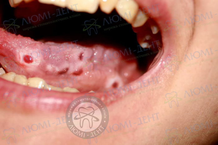 Виразки на язиці в роті фото Люмі-Дент