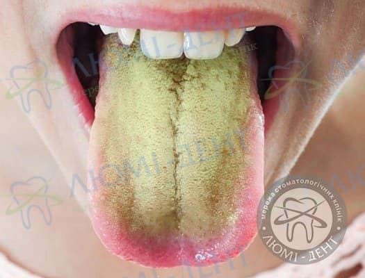 жовтий наліт на язику фото Люмі-Дент