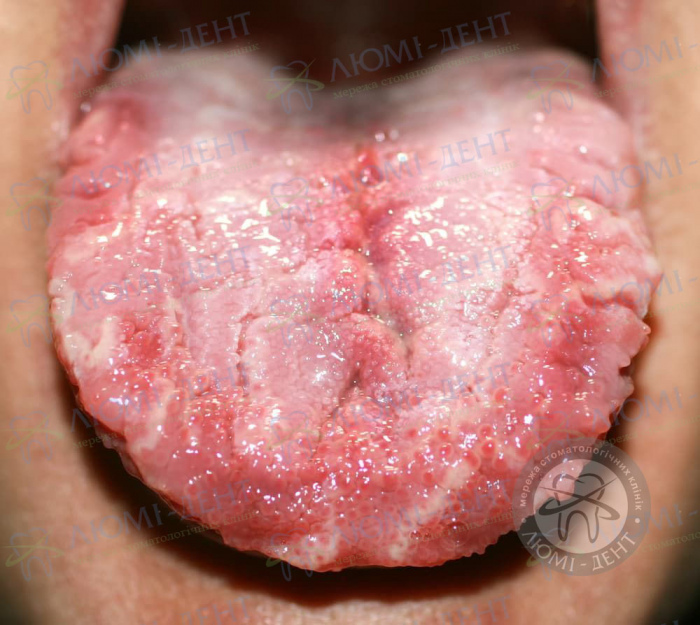 печіння кінчика язика фото ЛюміДент