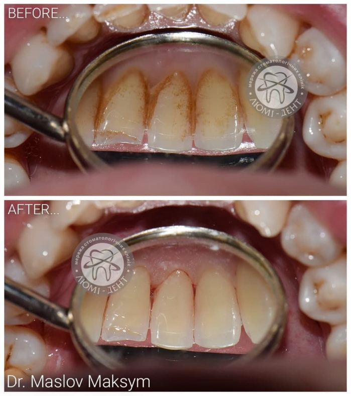 удаление камня с зубов фото Люми-Дент