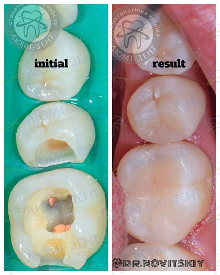 канали зубів фото Люмі-Дент