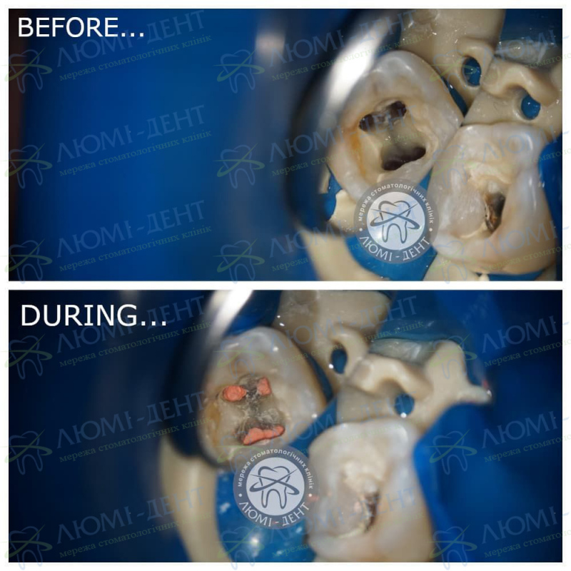 Лікування каналів зуба під мікроскопом фото Люмі-Дент