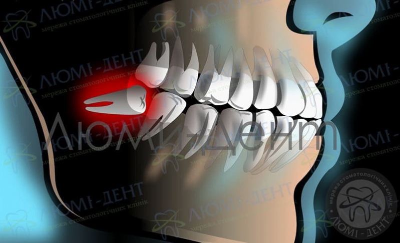 Зуби мудрості фото Люмі-Дент