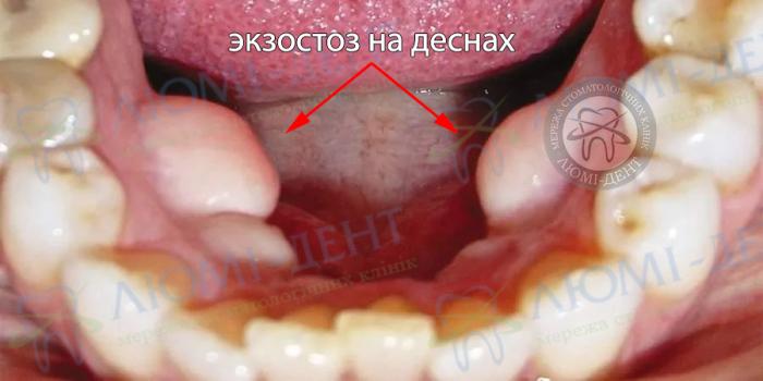 Экзостозы на деснах экзостоз как лечить фото люми-дент