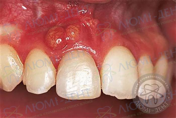 Причини гранулеми зуба фото Люмі-Дент