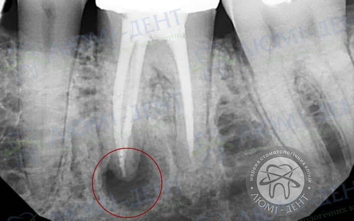 Рентген гранулемы зуба Киев фото Люми-Дент