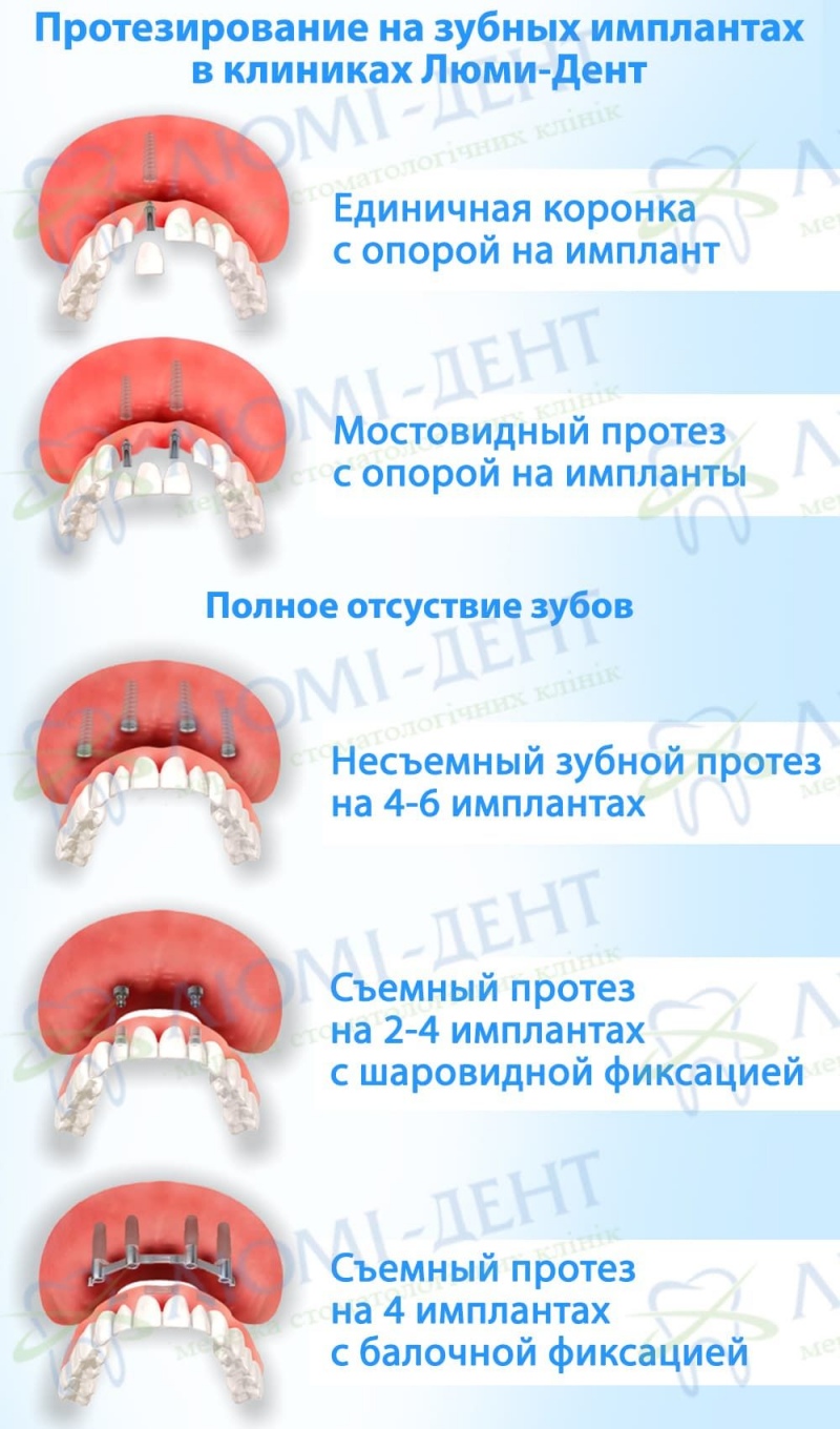 Виды протезов зубов на имплантах Имплантация зубов протезирование фото Люми-Дент