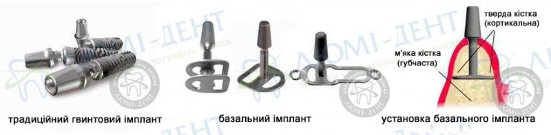 базальні імпланти зубів фото ЛюміДент