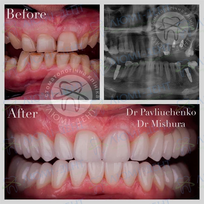 імплантація зуба фото Люмі-Дент
