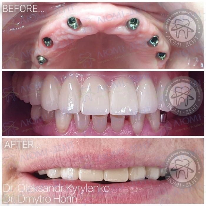 імпланти зубів імплантація фото Люмі-Дент