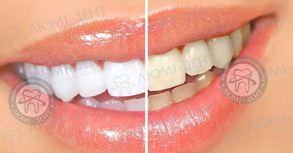 Как сделать белые зубы