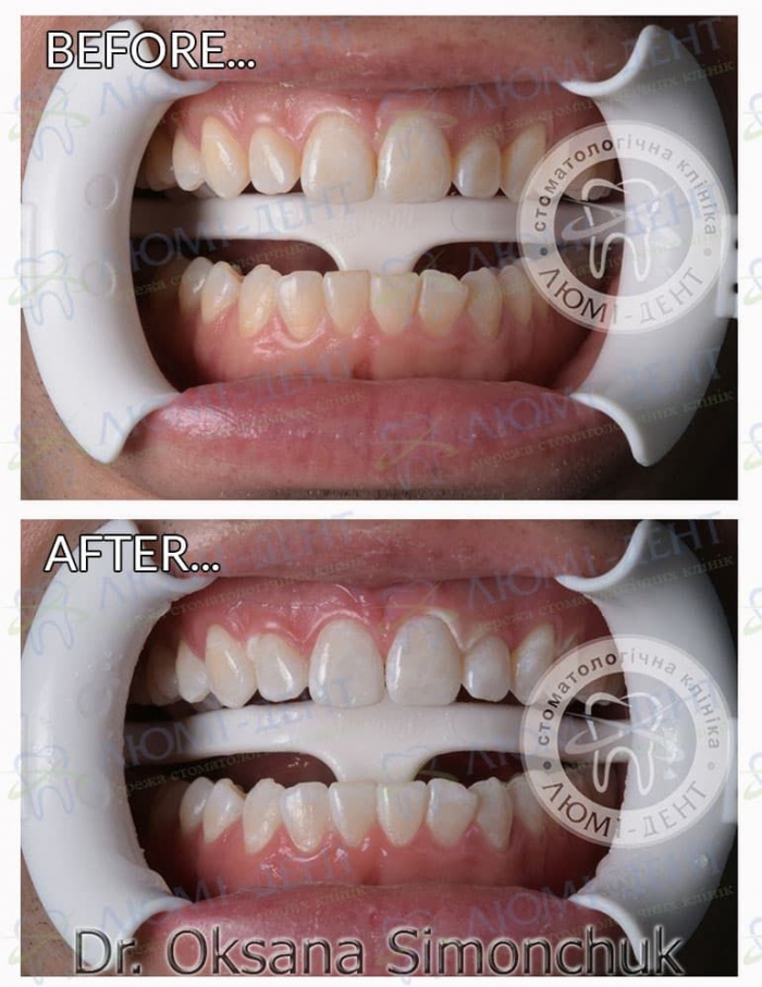 Як зробити зуби білими фото Люмі-Дент