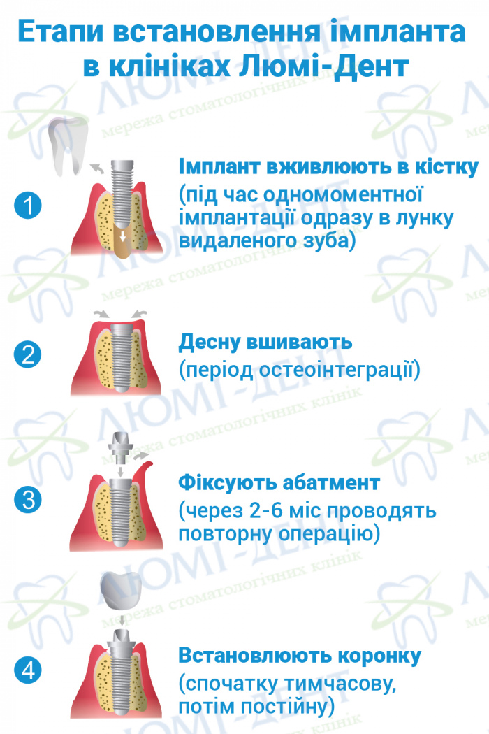 які імпланти краще фото ЛюміДент