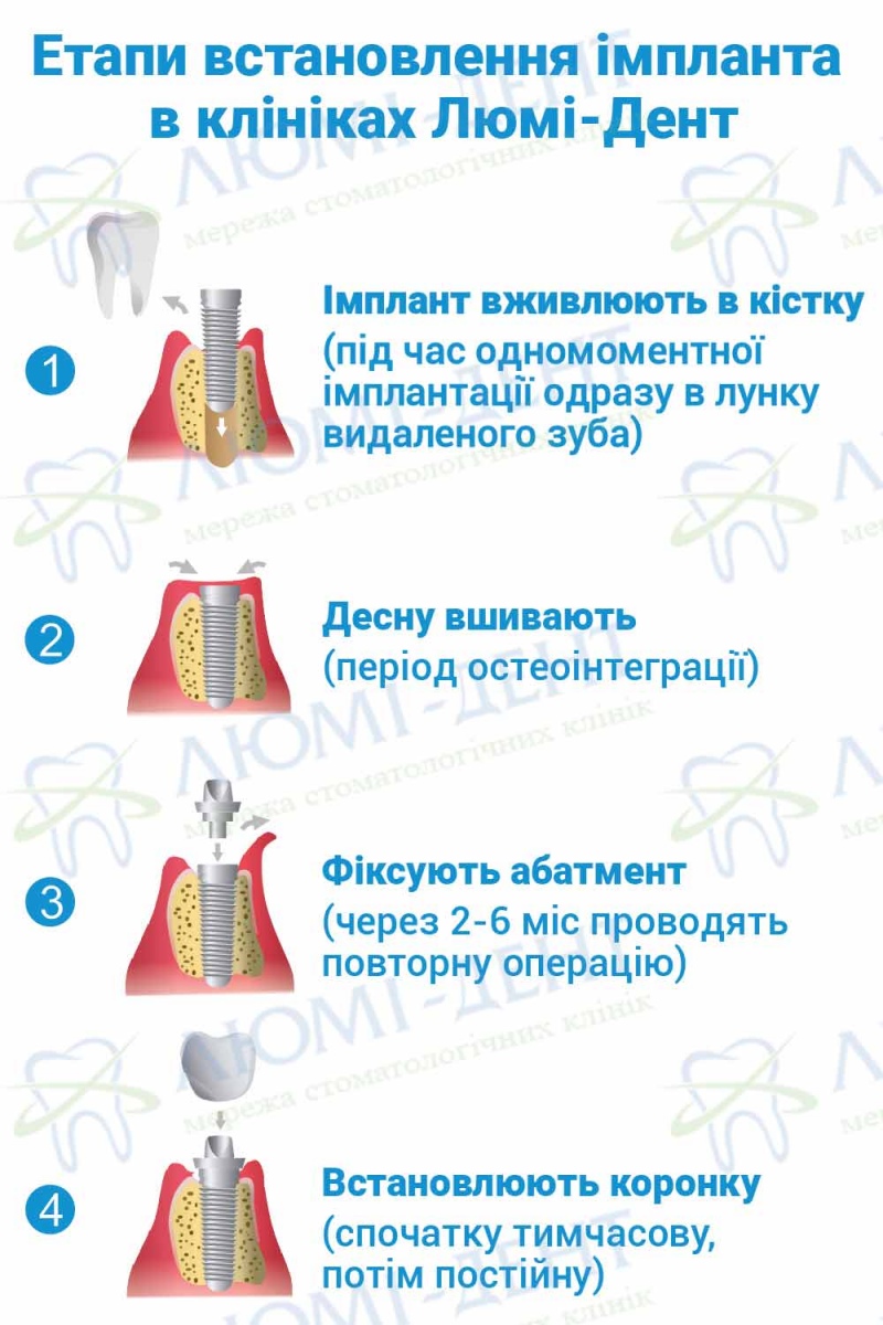Етапи встановлення імпланта в клініках Люмі-Дент Які імпланти кращі фото Люмі-Дент