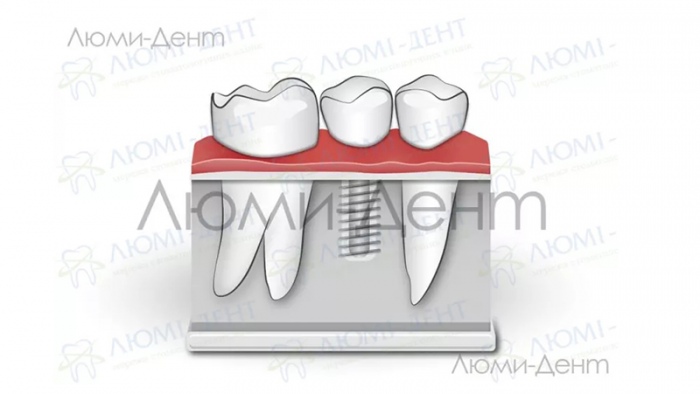 Які зубні імпланти кращі фото ЛюміДент
