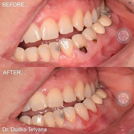 Чувствительность зубов лечение фото Киев Люми-Дент
