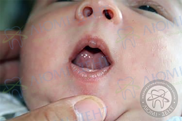 Короткая уздечка языка у ребенка фото лечение Люми-Дент Киев