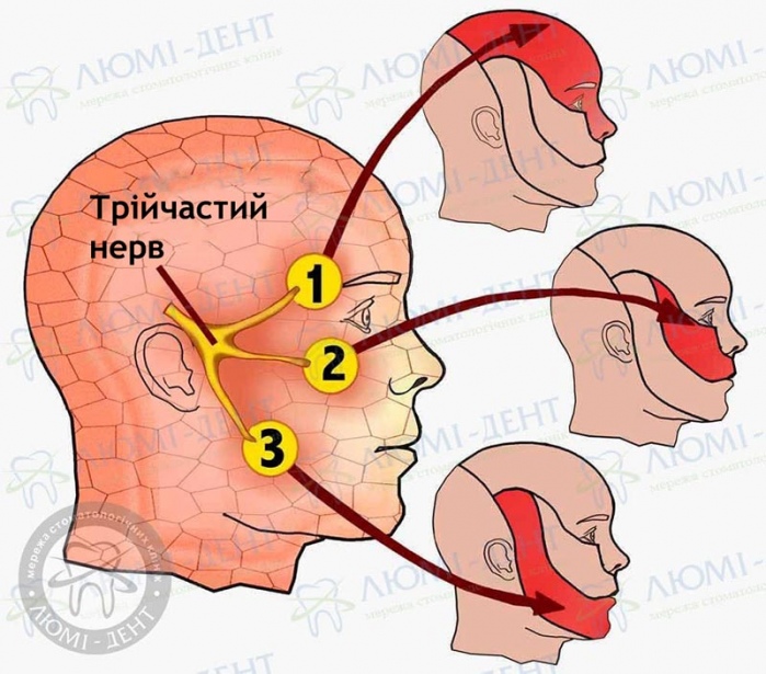 Трійчастий нерв фото Люмі-Дент