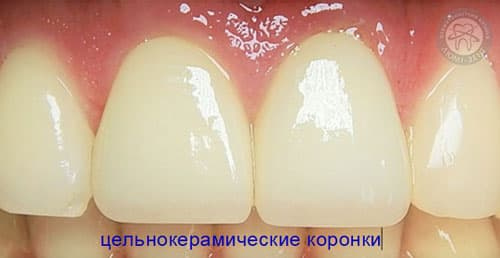 Металокераміка коронки Київ фото