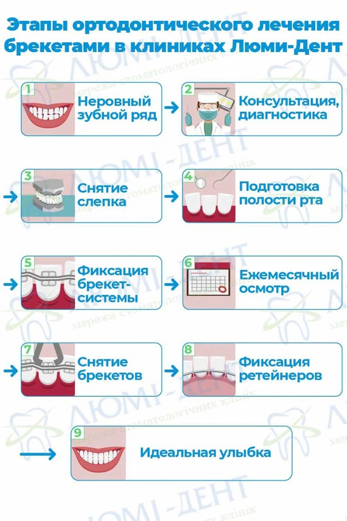 Этапы установки брекетов в клиниках Люми-Дент Мезиальный прикус лечение прогения фото Люми-Дент