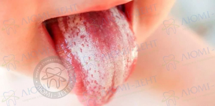 Молочниця в роті у дитини фото ЛюміДент