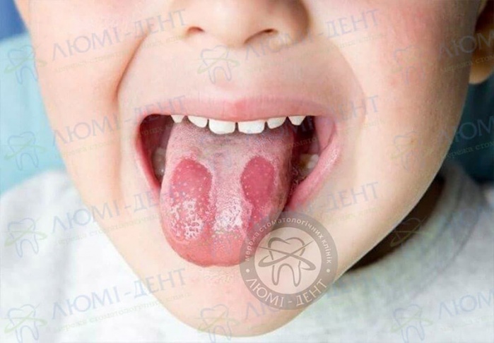 Молочниця в роті у дитини фото Люмі-Дент