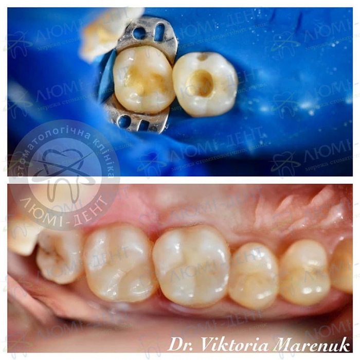 Народні методи лікування зубного болю фото Люмі-Дент