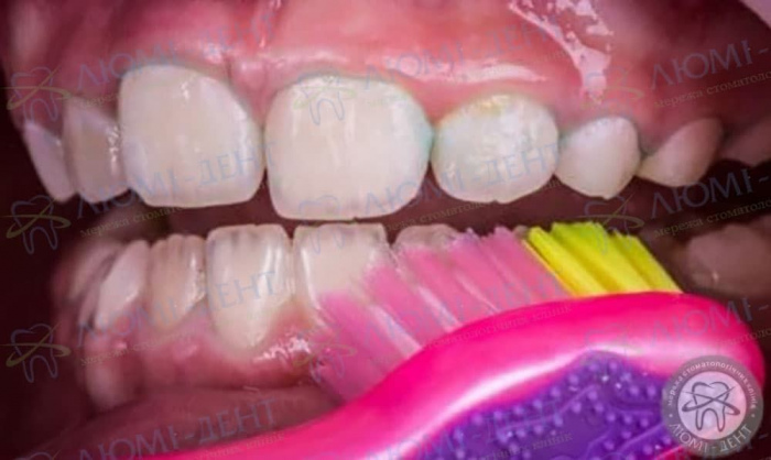 Полоскання при зубному болю фото ЛюміДент