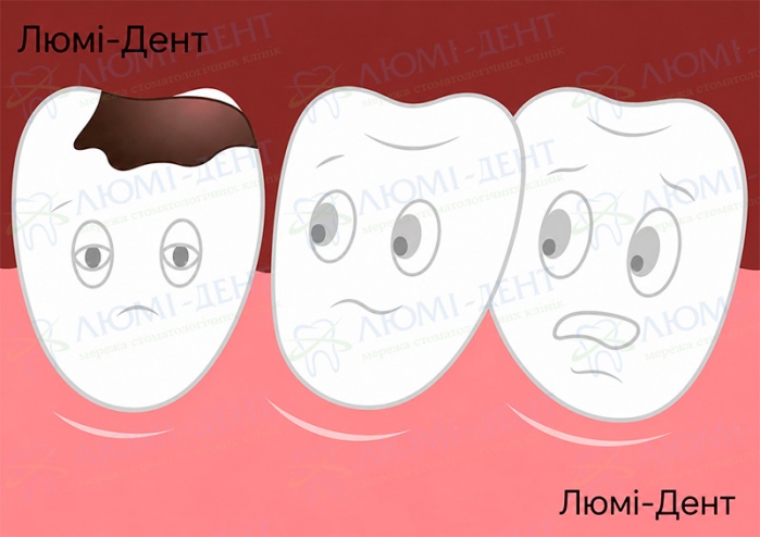 Карієс зуба Що робити коли болить зуб фото Люмі-Дент