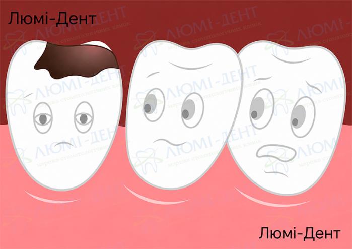 Карієс зуба Що робити коли болить зуб фото Люмі-Дент