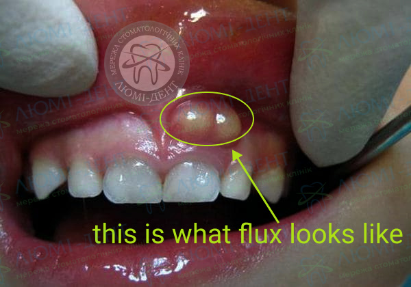 The gums are swollen photo LumiDent
