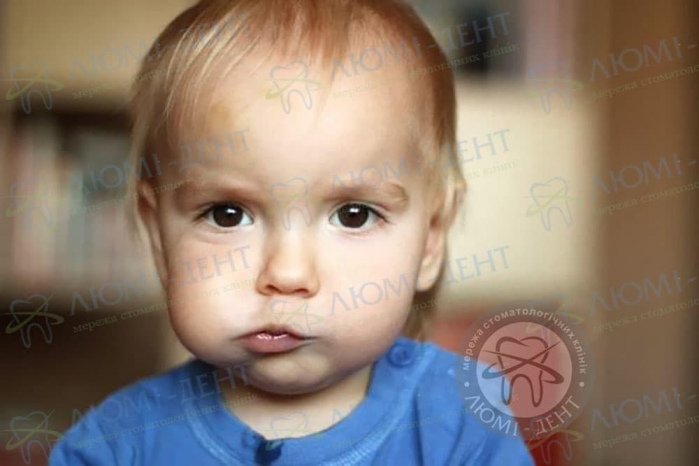 Опухла щека у ребенка фото ЛюмиДент