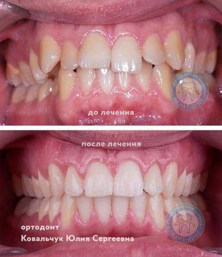 Alignment of teeth - the result in the clinic Lumi-Dent Good Children's Orthodontist Dentist Kiev Lumi-dent