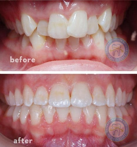 The result of the work of our doctors Orthodontist dentist pediatrician bite correction Kyiv LumiDent