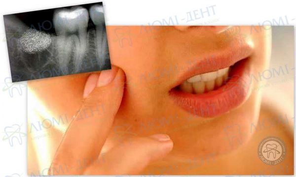 Основные причины развития периостита челюсти Люми-Дент 
