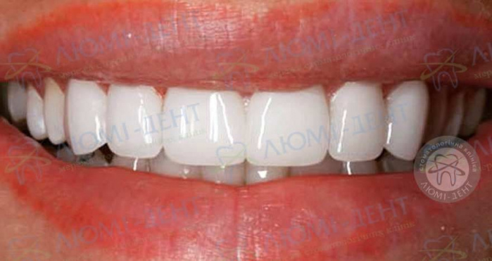 Люминиры для зубов фото до после Люмидент
