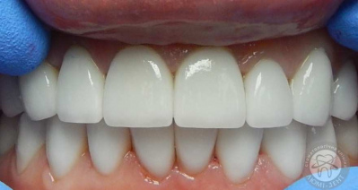 dental prosthesis