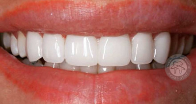 протезирование зубов киев, фото