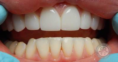 протезування зубів київ, фото