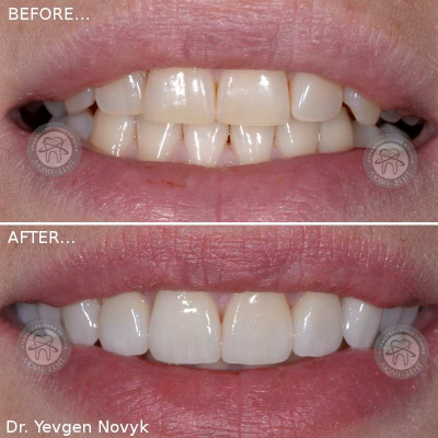 dental prosthesis