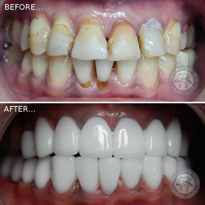 Dental crowns on teeth which are better photo Lumi-Dent 