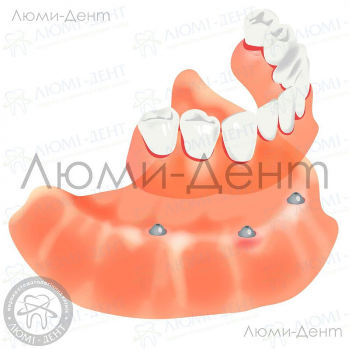 уход за акриловыми зубными протезами фото ЛюмиДент