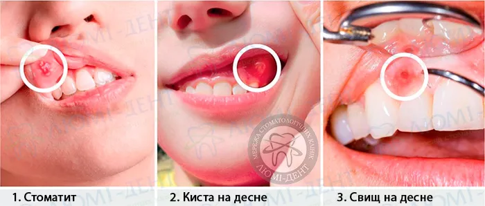 Причины возникновения белых точек на деснах Белые пятна на деснах фото ЛюмиДент