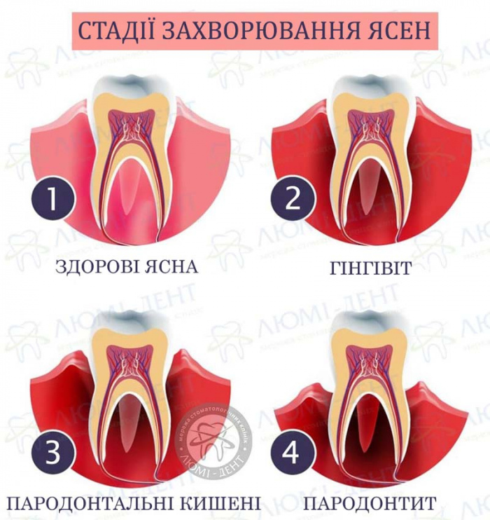 Захворювання ясен фото ЛюміДент