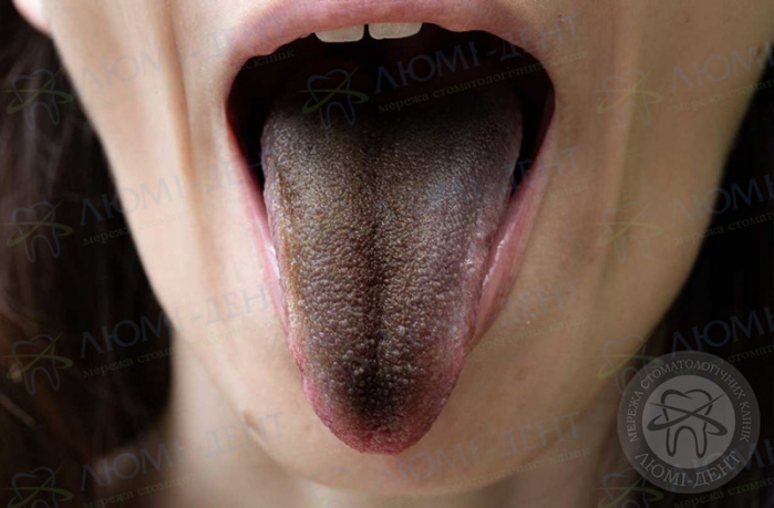 чорний наліт на язиці фото ЛюміДент